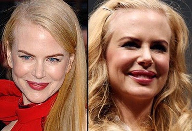Nicole Kidman Plastic Surgery Photos Before Amp After Surgery4