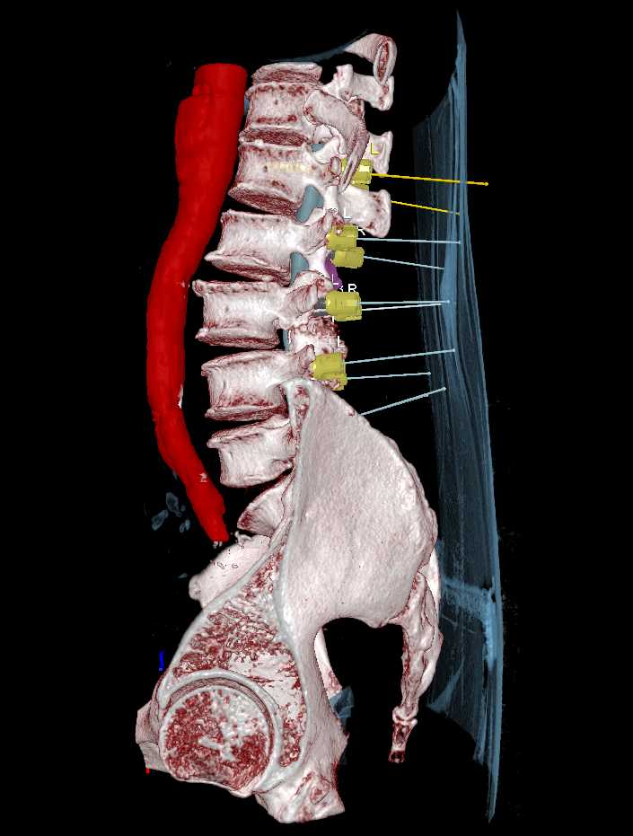 Pdf Enhancing Surgical Precision Unveiling The Impact Of Preoperative Colonoscopy In Anal